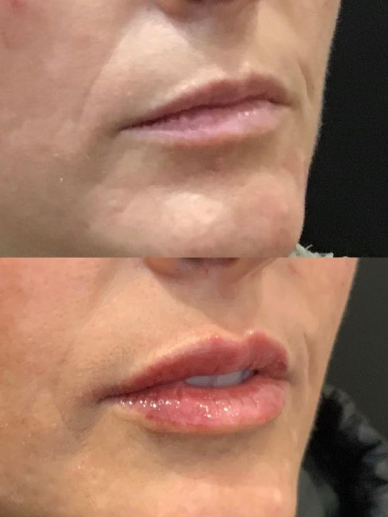Lips Before & After Gallery - Patient 715647 - Image 2