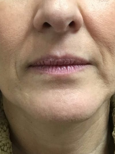 Lips Before & After Gallery - Patient 275972 - Image 1