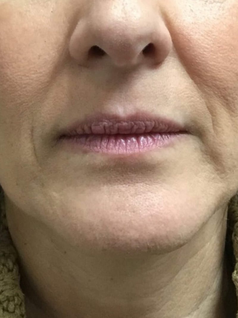 Lips Before & After Gallery - Patient 275972 - Image 1