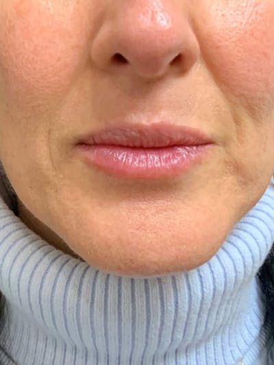 Lips Before & After Gallery - Patient 275972 - Image 2