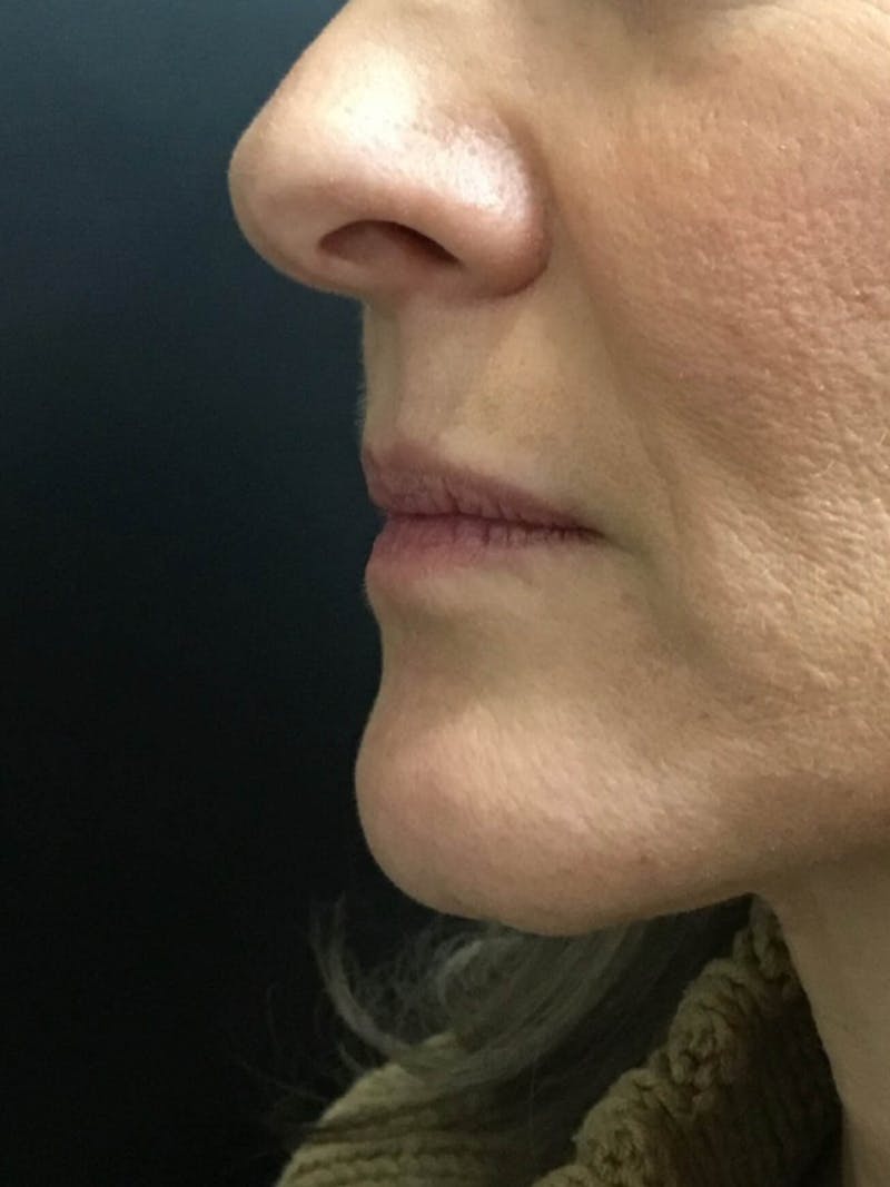 Lips Before & After Gallery - Patient 292354 - Image 1