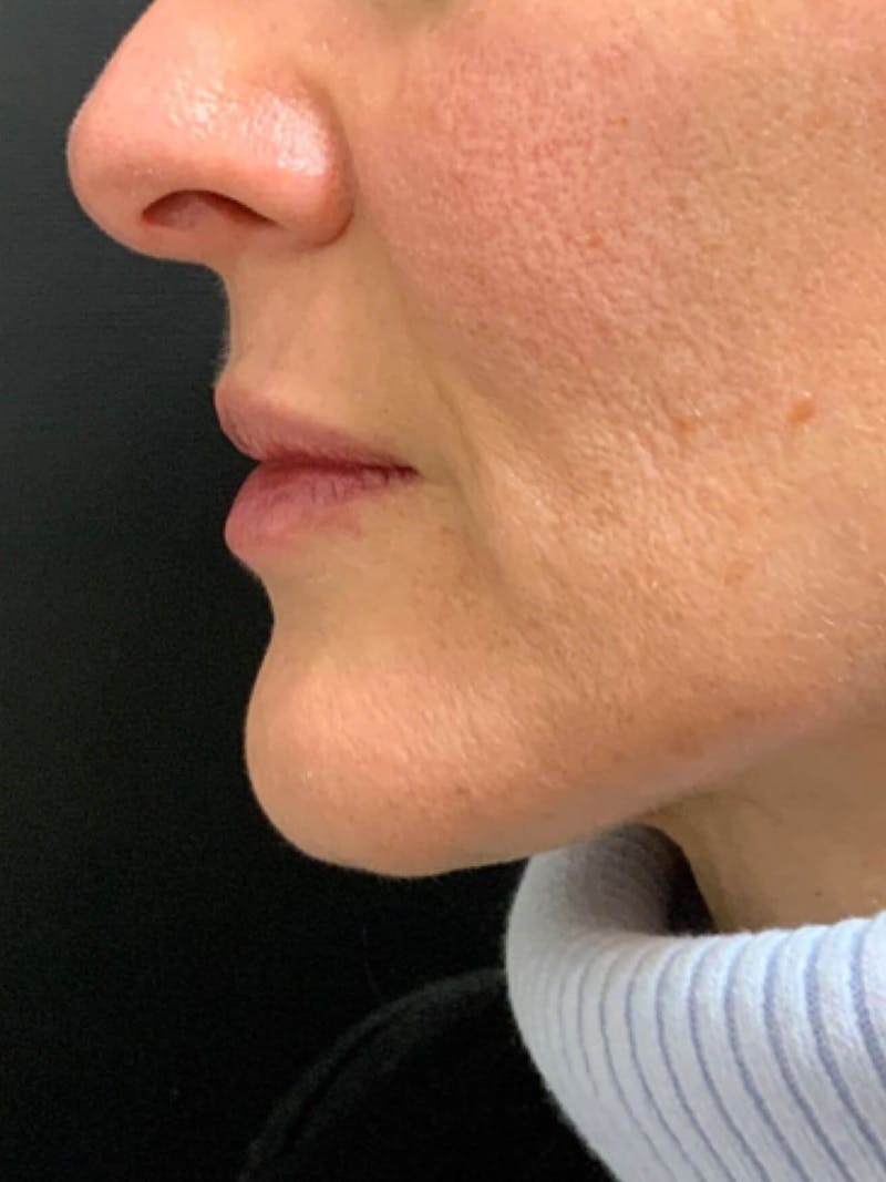 Lips Before & After Gallery - Patient 292354 - Image 2