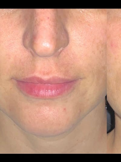 Lips Before & After Gallery - Patient 272988 - Image 1