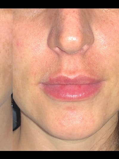 Lips Before & After Gallery - Patient 272988 - Image 2