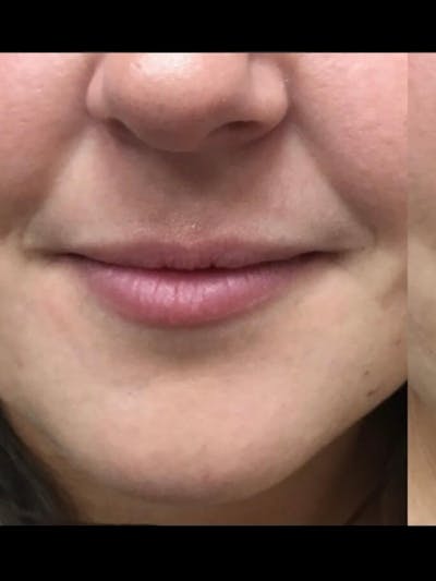 Lips Before & After Gallery - Patient 372550 - Image 1