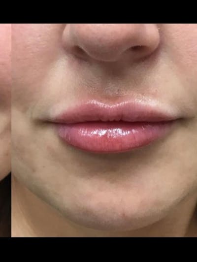 Lips Before & After Gallery - Patient 372550 - Image 2