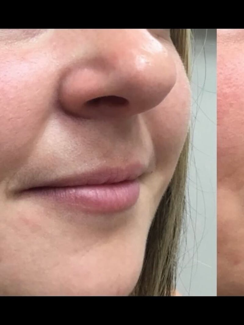 Lips Before & After Gallery - Patient 372550 - Image 3