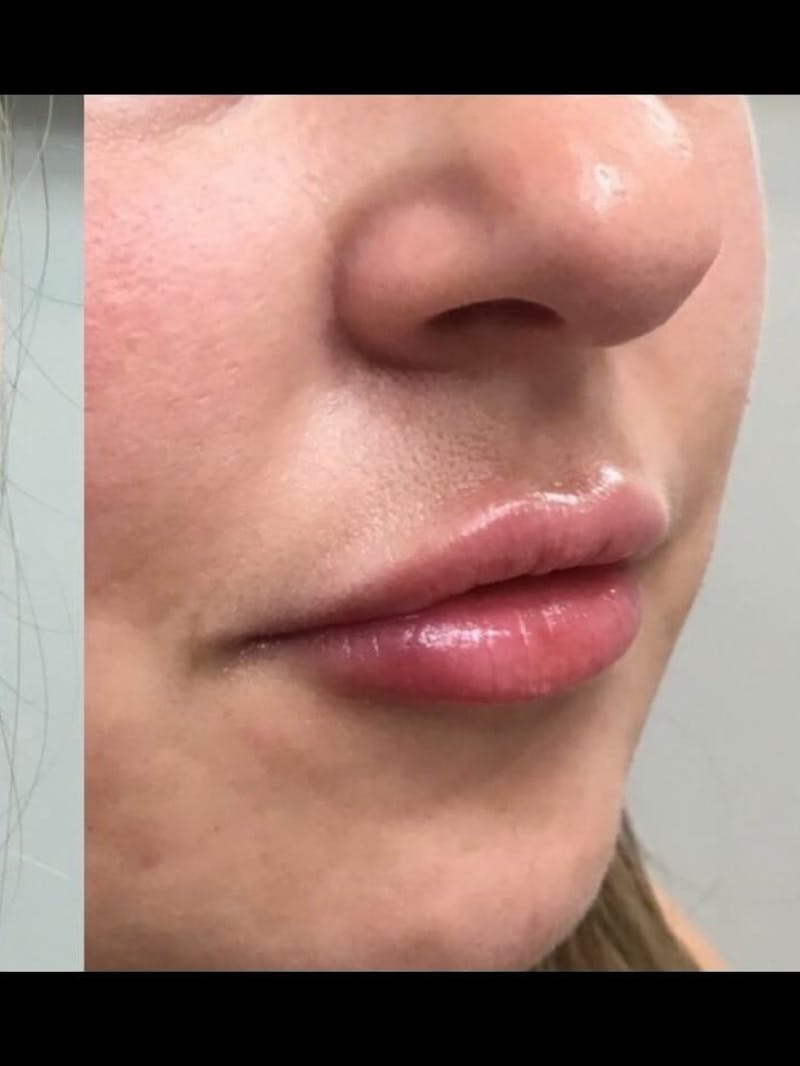 Lips Before & After Gallery - Patient 372550 - Image 4
