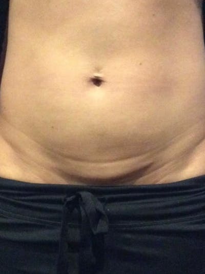 Skin Before & After Gallery - Patient 393283 - Image 1