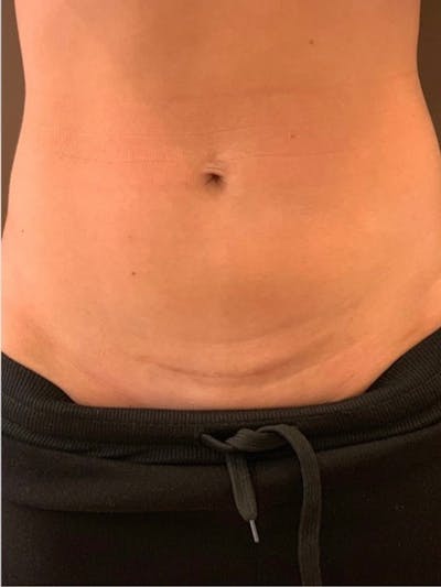 Skin Before & After Gallery - Patient 393283 - Image 2