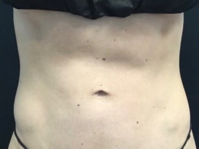 Skin Before & After Gallery - Patient 317341 - Image 1