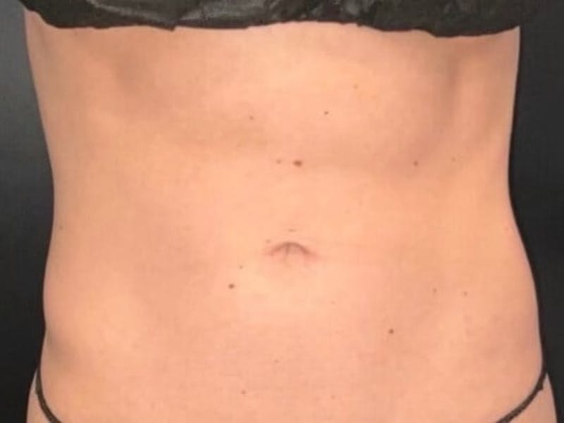 Skin Before & After Gallery - Patient 317341 - Image 2