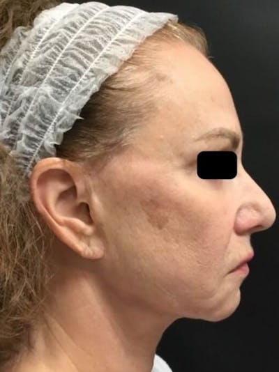 Skin Before & After Gallery - Patient 264420 - Image 1