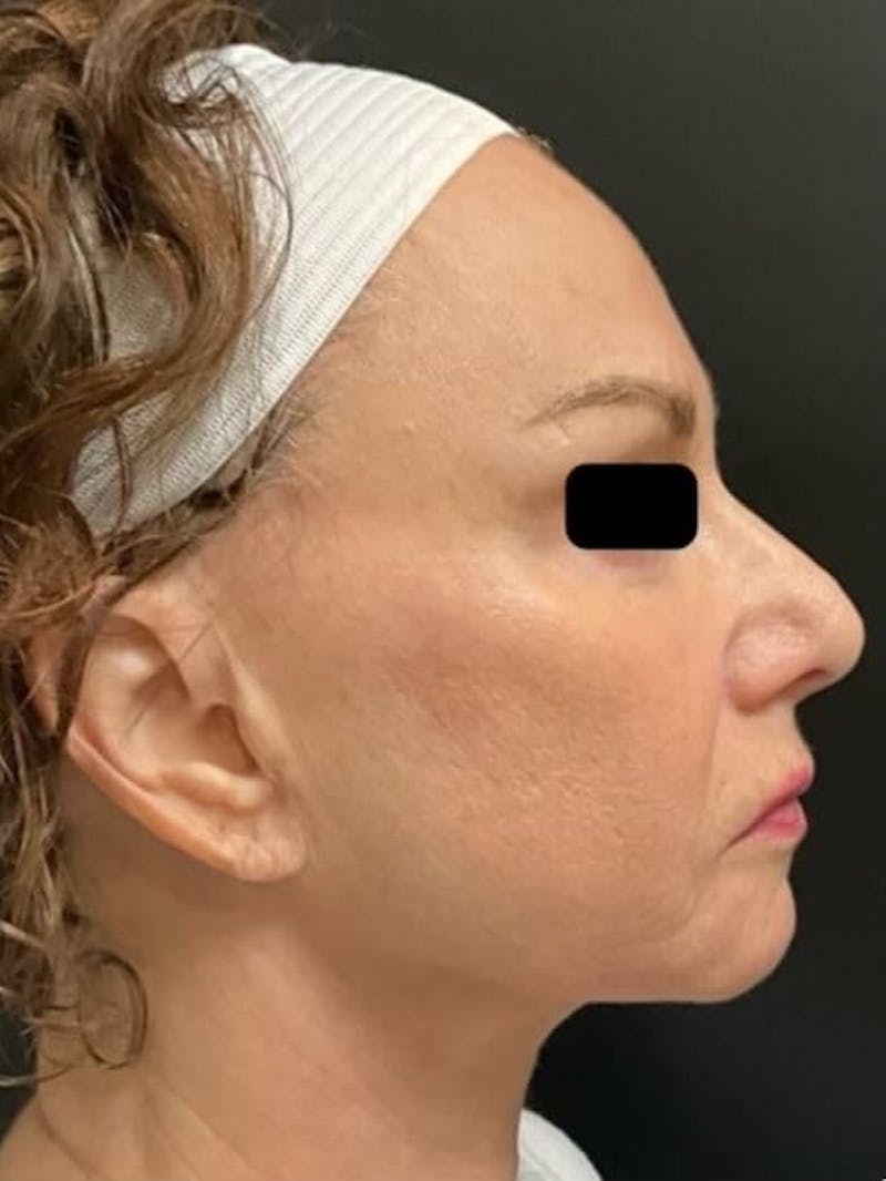Skin Before & After Gallery - Patient 264420 - Image 2