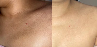 Skin Before & After Gallery - Patient 259015 - Image 1