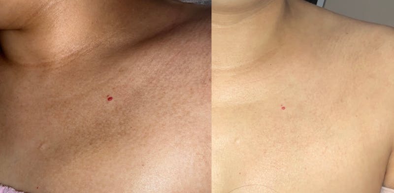 Skin Before & After Gallery - Patient 259015 - Image 1