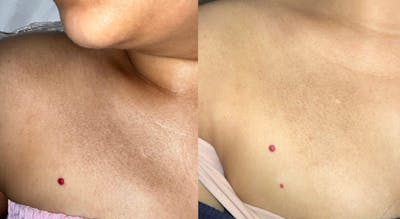 Skin Before & After Gallery - Patient 259015 - Image 2