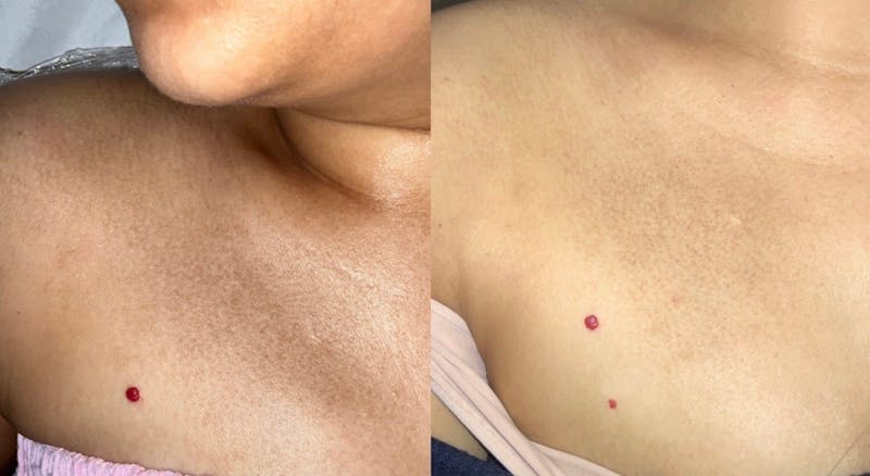 Skin Before & After Gallery - Patient 259015 - Image 2