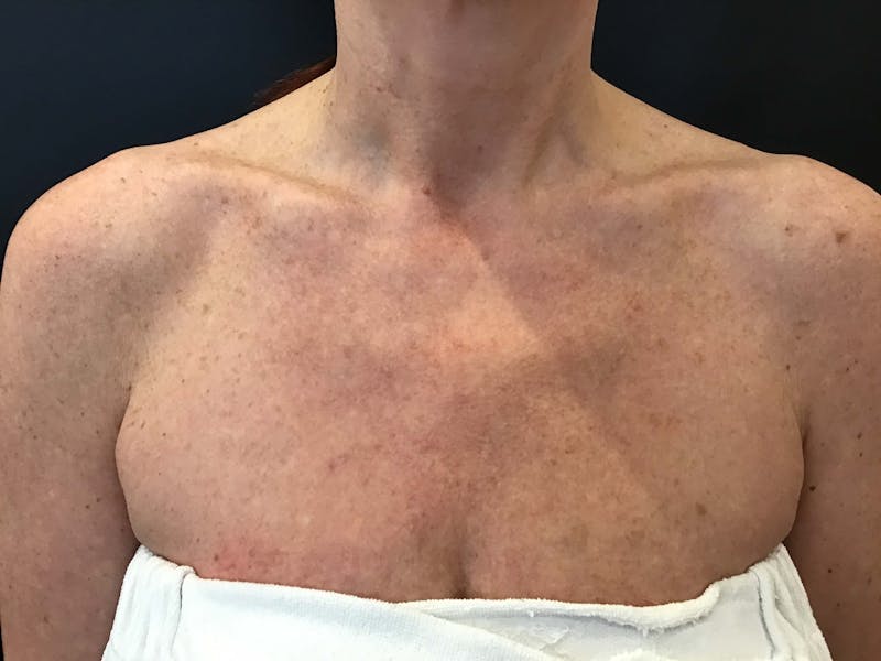 Skin Before & After Gallery - Patient 355776 - Image 1