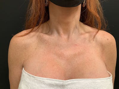 Skin Before & After Gallery - Patient 355776 - Image 2