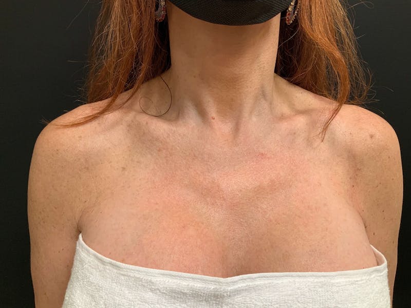 Skin Before & After Gallery - Patient 355776 - Image 2