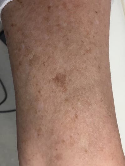 Skin Before & After Gallery - Patient 216293 - Image 1