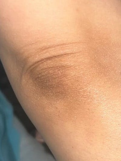 Skin Before & After Gallery - Patient 327589 - Image 2