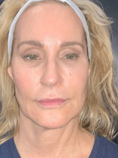 Skin Before & After Gallery - Patient 377441 - Image 1