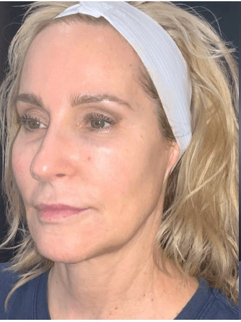Face Before & After Gallery - Patient 234873 - Image 4