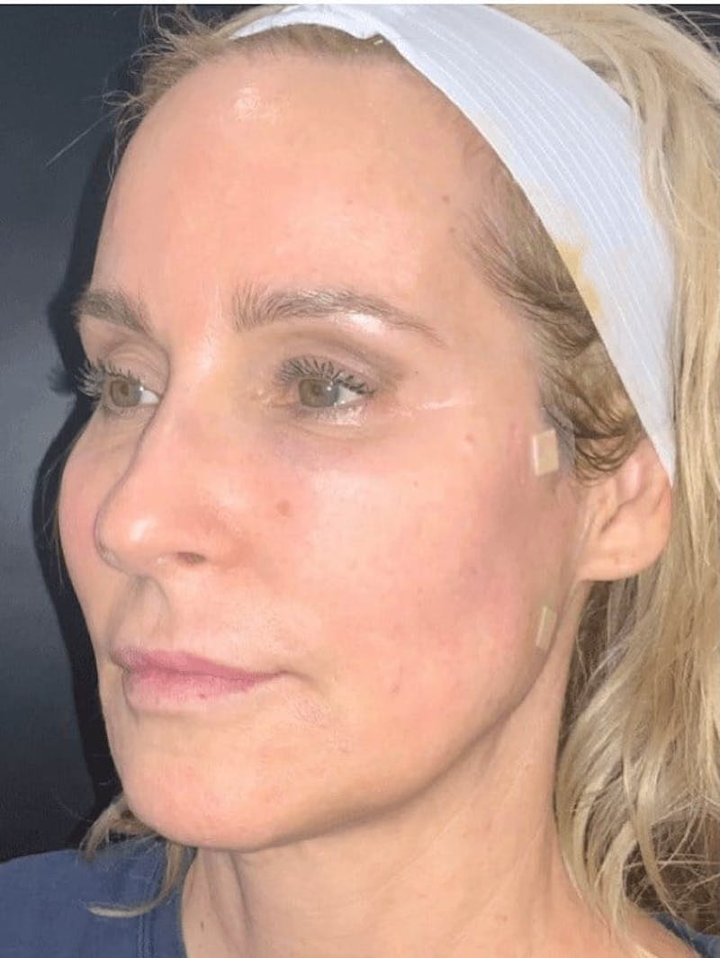 Face Before & After Gallery - Patient 234873 - Image 3