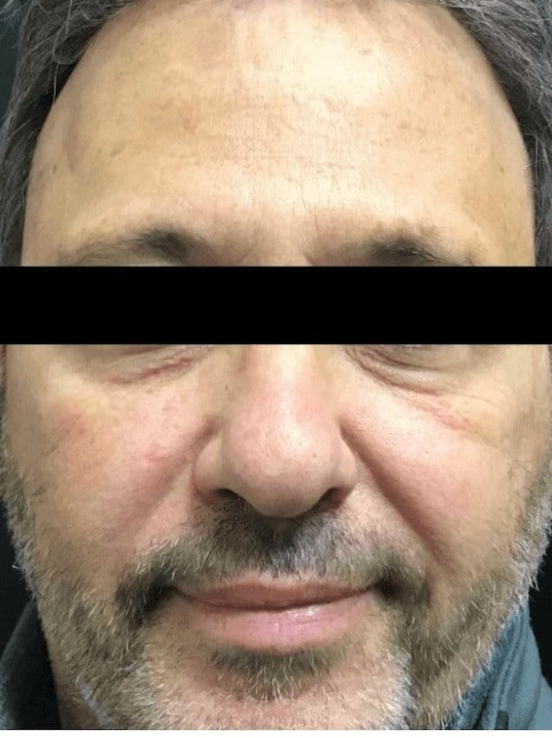 Skin Before & After Gallery - Patient 598891 - Image 1