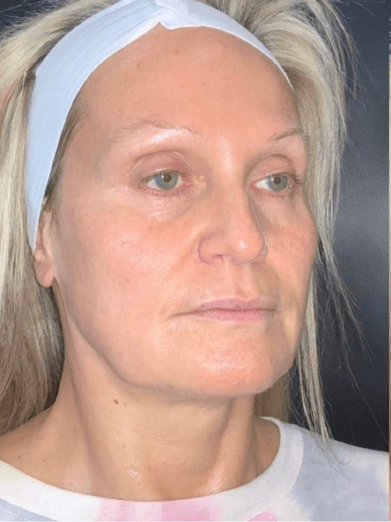 Skin Before & After Gallery - Patient 310553 - Image 1