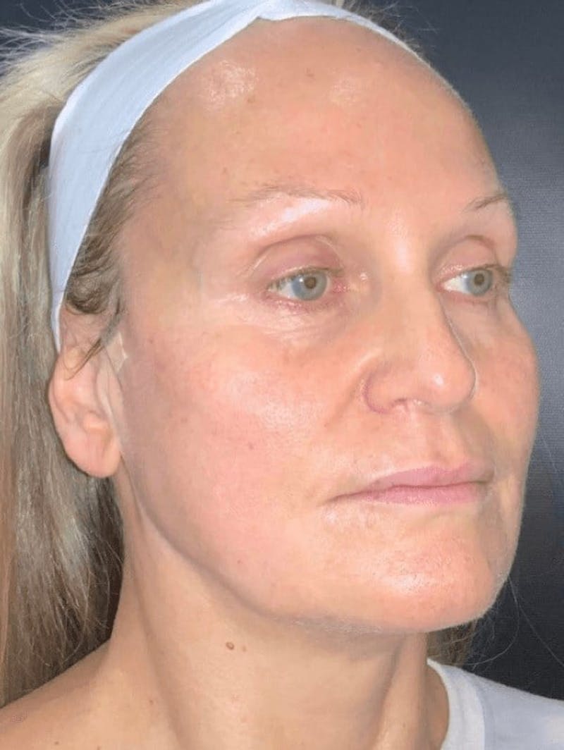 Skin Before & After Gallery - Patient 310553 - Image 2