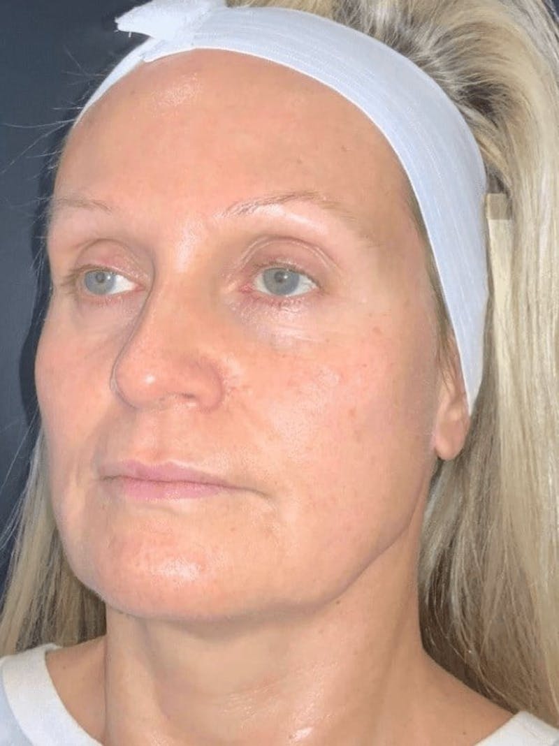 Skin Before & After Gallery - Patient 310553 - Image 3