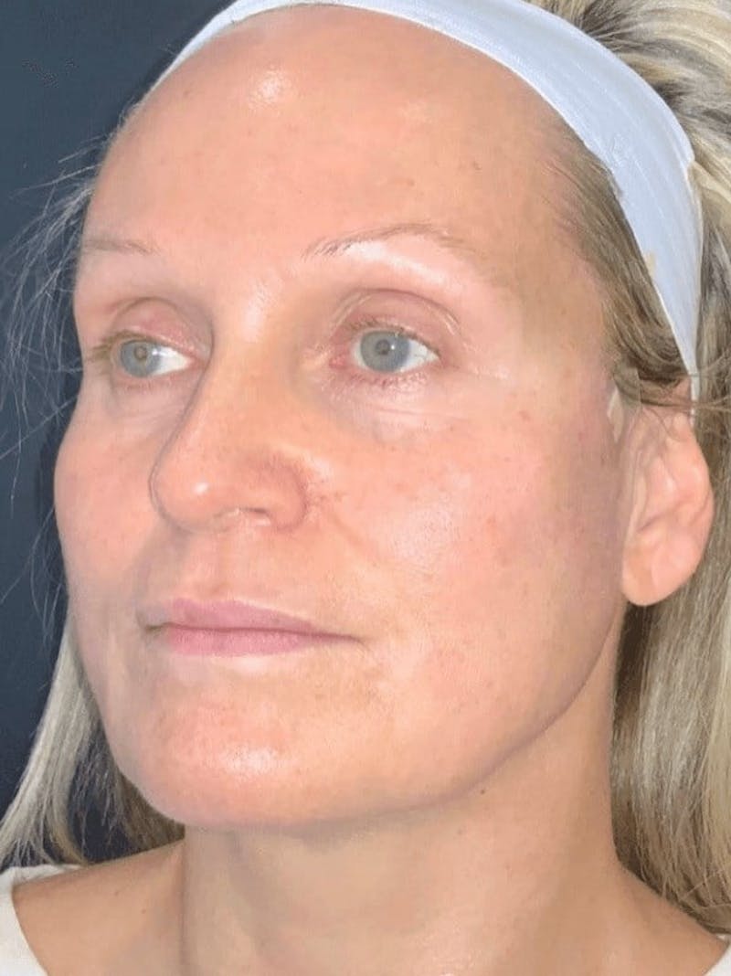 Skin Before & After Gallery - Patient 310553 - Image 4