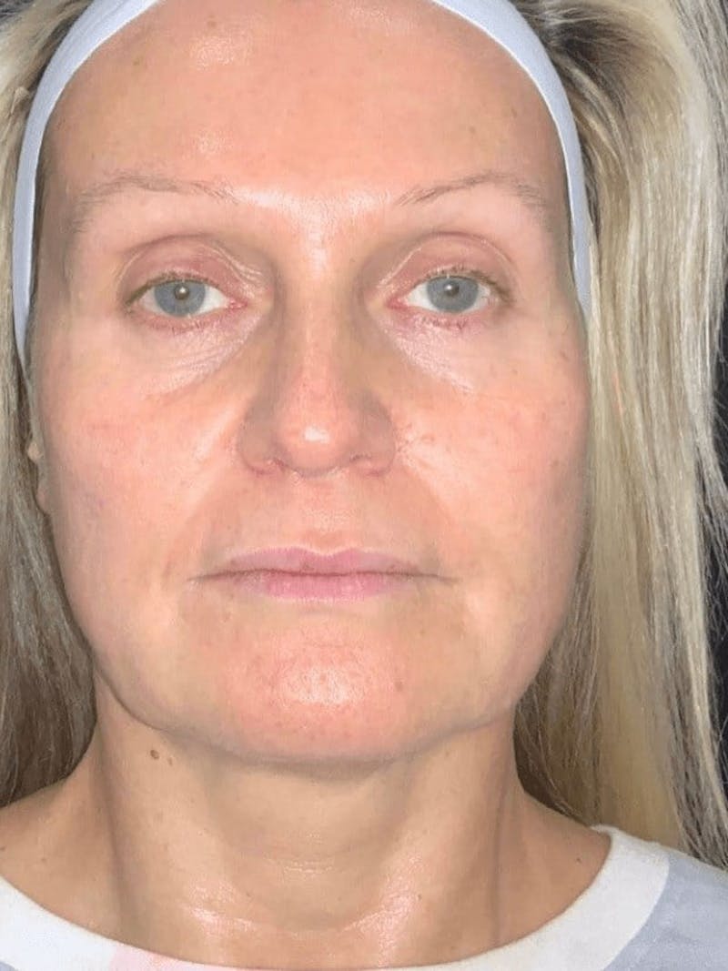 Skin Before & After Gallery - Patient 310553 - Image 5