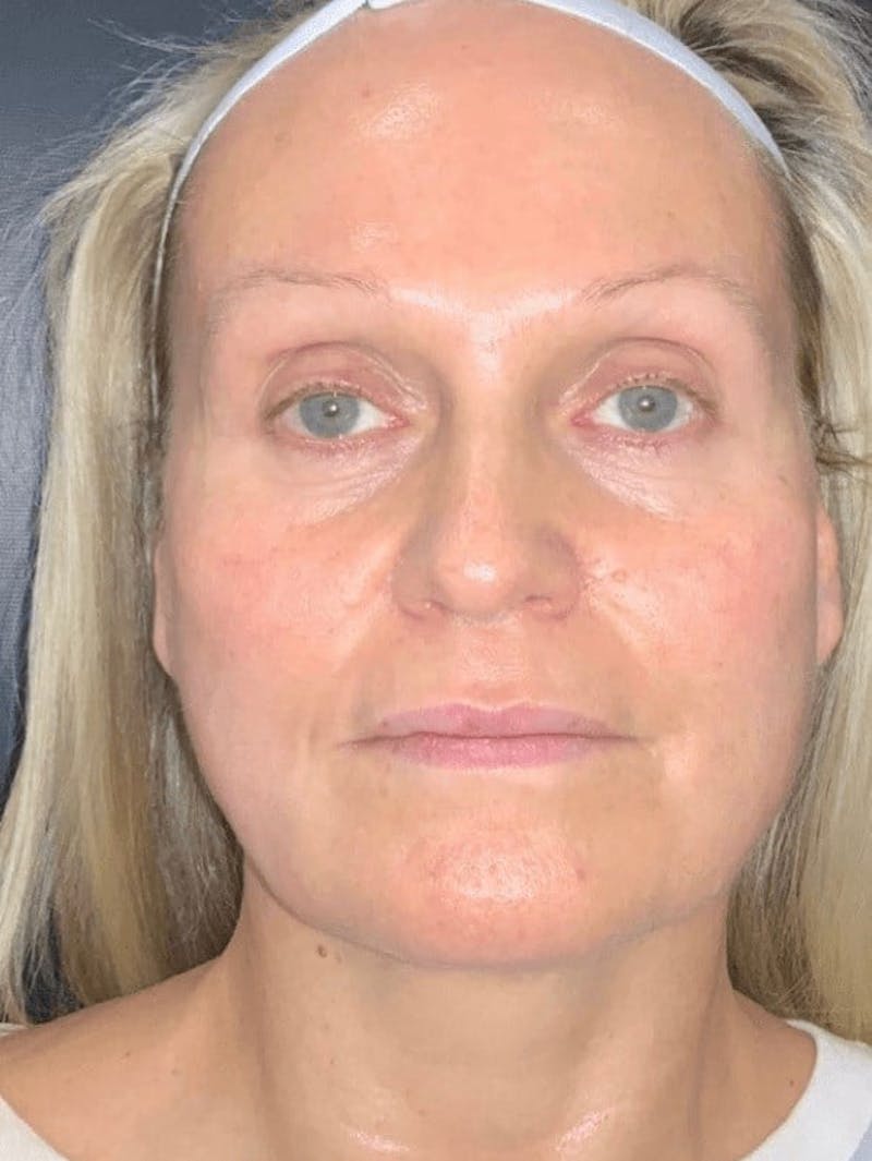 Skin Before & After Gallery - Patient 310553 - Image 6