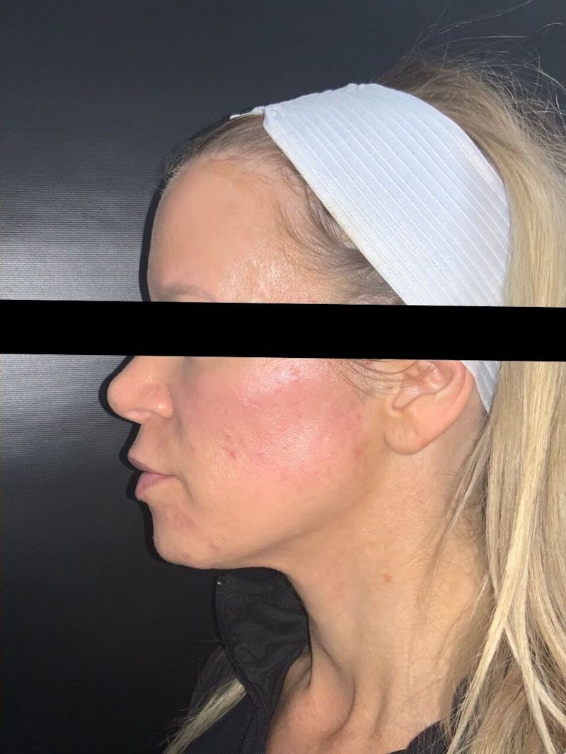 Lips Before & After Gallery - Patient 197464 - Image 2