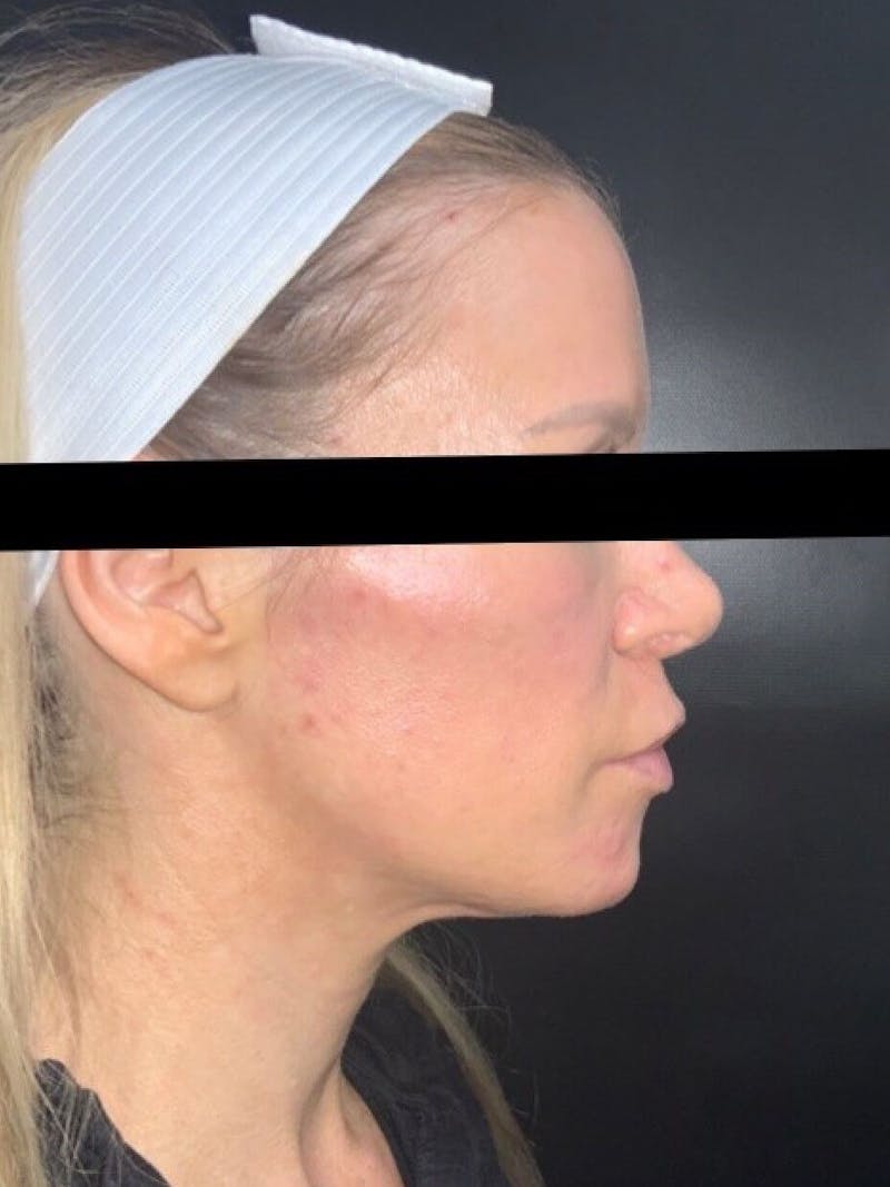 Lips Before & After Gallery - Patient 197464 - Image 4