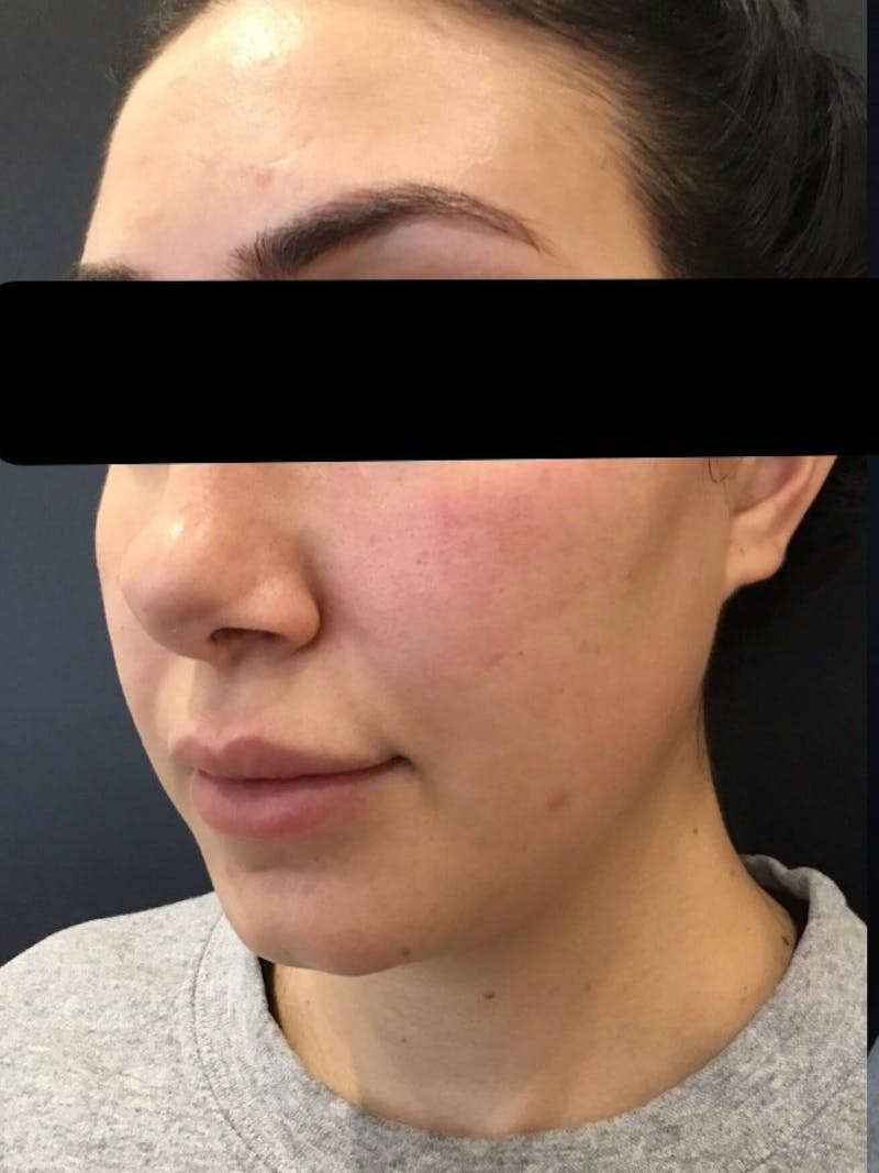 Lips Before & After Gallery - Patient 854226 - Image 1