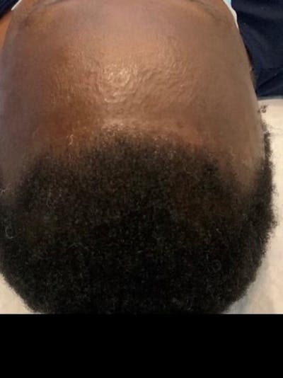 Hair Before & After Gallery - Patient 226195 - Image 1