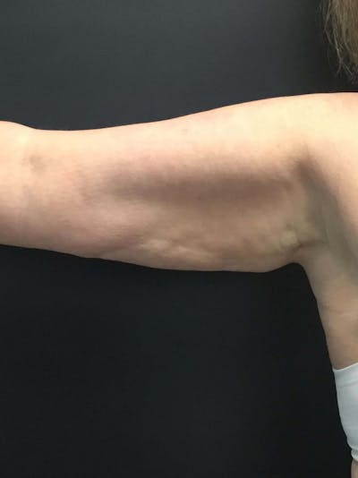 Arms Before & After Gallery - Patient 196904 - Image 1
