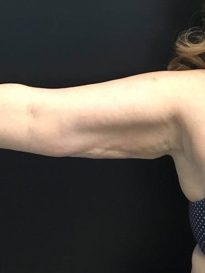 Arms Before & After Gallery - Patient 196904 - Image 2