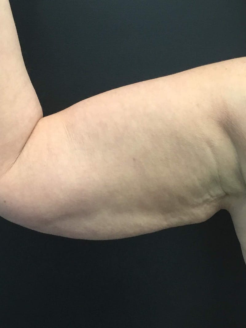 Arms Before & After Gallery - Patient 196904 - Image 3