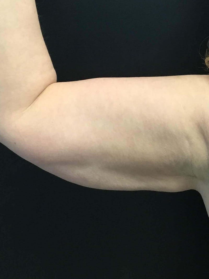 Arms Before & After Gallery - Patient 196904 - Image 4