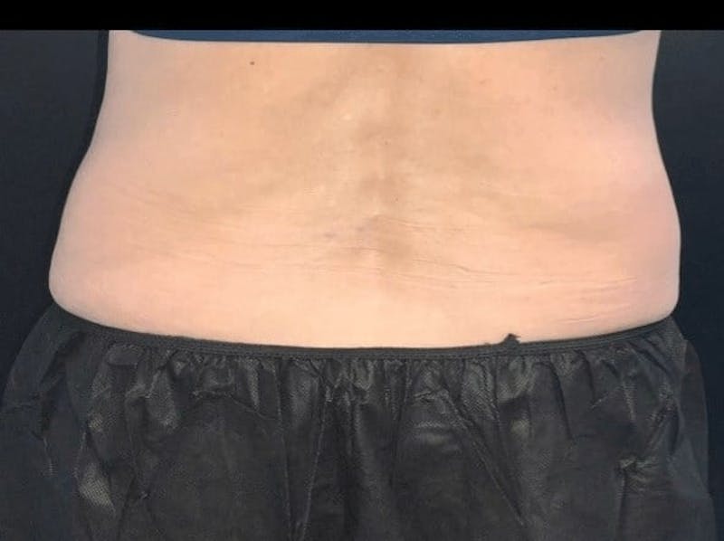 Back Before & After Gallery - Patient 384330 - Image 2
