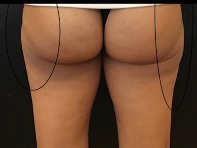 Thighs Before & After Gallery - Patient 140123 - Image 2