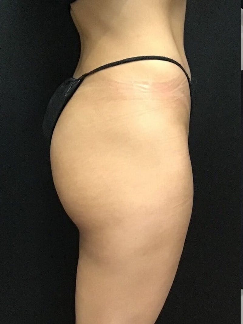 Buttocks Before & After Gallery - Patient 358813 - Image 1