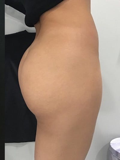 Buttocks Before & After Gallery - Patient 358813 - Image 2