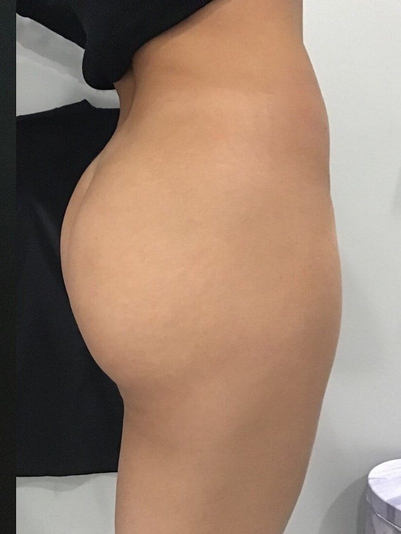 Buttocks Before & After Gallery - Patient 358813 - Image 2